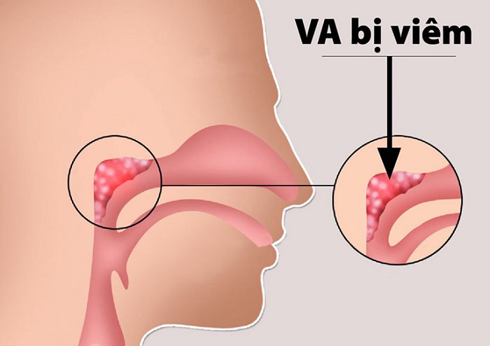 Nạo V.A sớm sau khi khô tai.